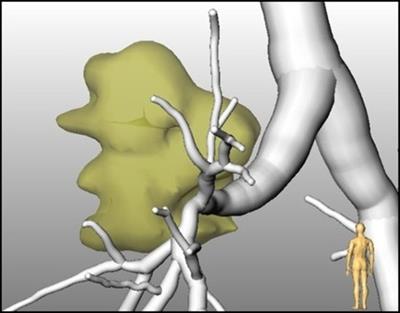 Computer-assisted image-based risk analysis and planning in lung surgery - a review